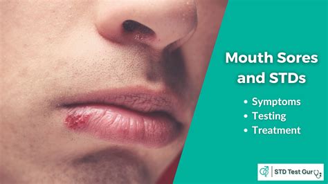 What are signs of STDs in your mouth?