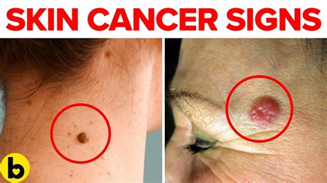 What are skin tags a warning for?