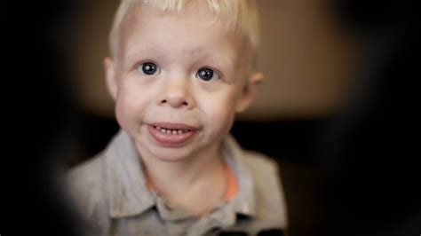 What are some interesting facts about Williams syndrome?