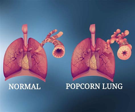 What are symptoms of popcorn lung?