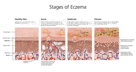 What are the 3 stages of eczema?