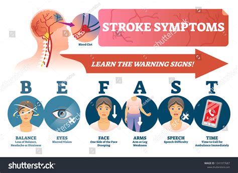 What are the 4 signs of an impending stroke?