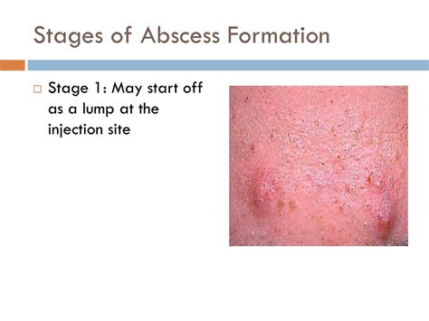What are the 4 stages of abscess?