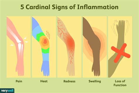 What are the 5 classic signs of inflammation?