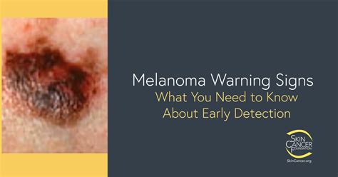 What are the 5 warning signs of melanoma?