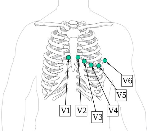 What are the 6 leads?