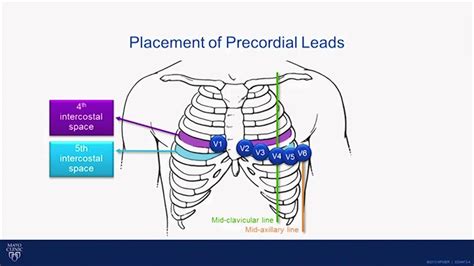 What are the benefits of a 3 lead ECG?