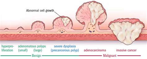 What are the chances a 10 mm polyp is cancerous?