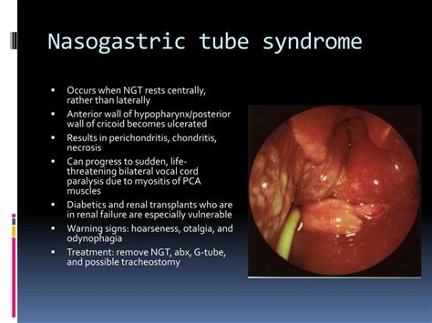 What are the complications of nasogastric tube?