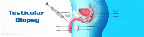 What are the disadvantages of testicular biopsy?