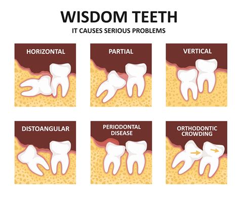 What are the disadvantages of wisdom teeth removal?