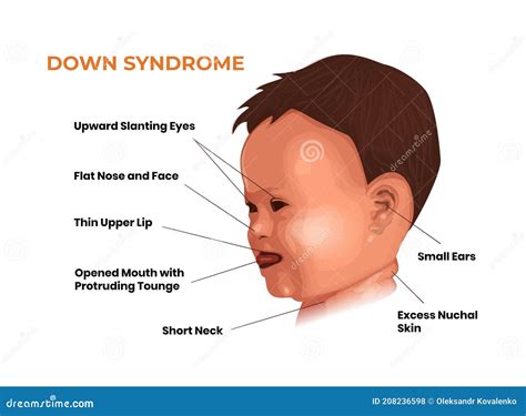 What are the early signs of Down syndrome in babies?