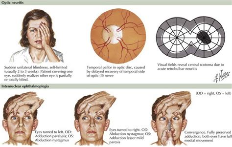 What are the early signs of MS in the eyes?