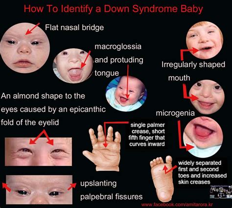 What are the facial features of MS?