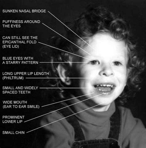 What are the facial features of Williams syndrome?