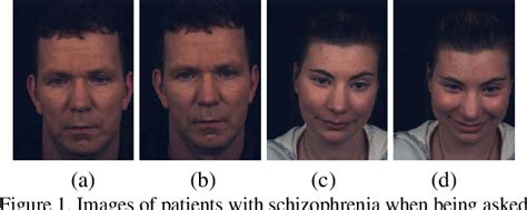 What are the facial features of schizophrenia?