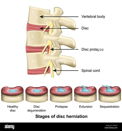 What are the final stages of a herniated disc?