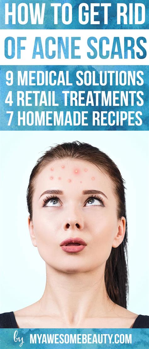 What are the hardest acne scars to get rid of?