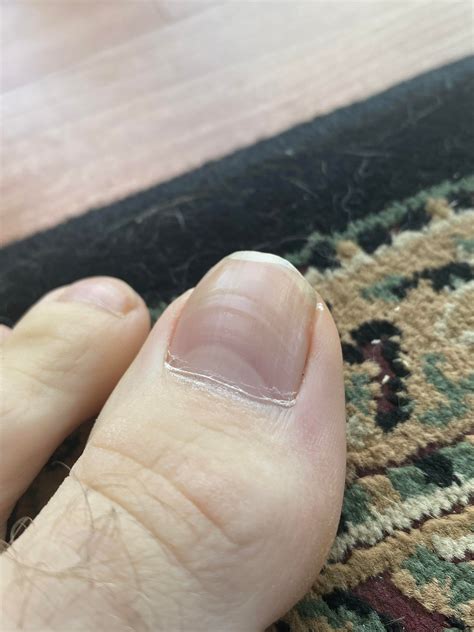 What are the horizontal lines in my nails?