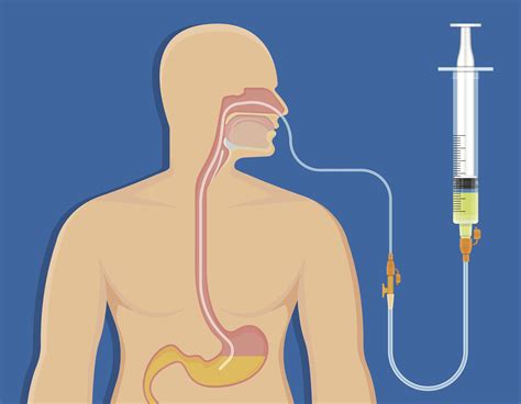 What are the indications for the insertion of a nasogastric feeding tube?