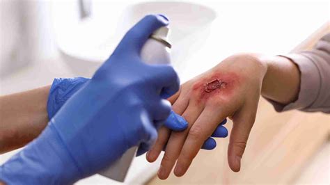 What are the injuries of a hot glue gun?