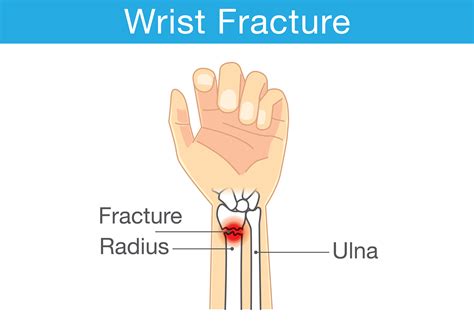 What are the long term effects of a broken wrist?