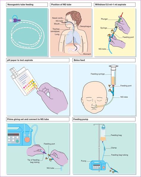 What are the methods of nasogastric feeding?