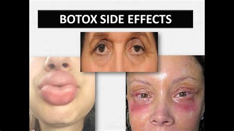 What are the negative side effects to Botox?