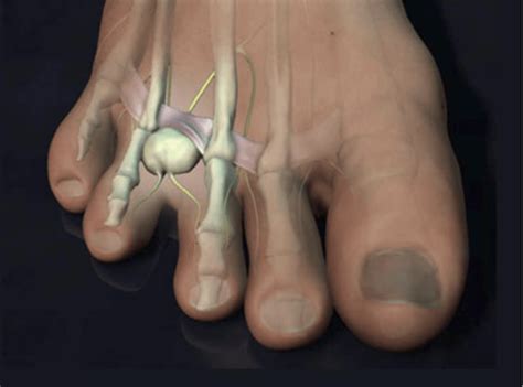 What are the risk factors for Morton's toe?