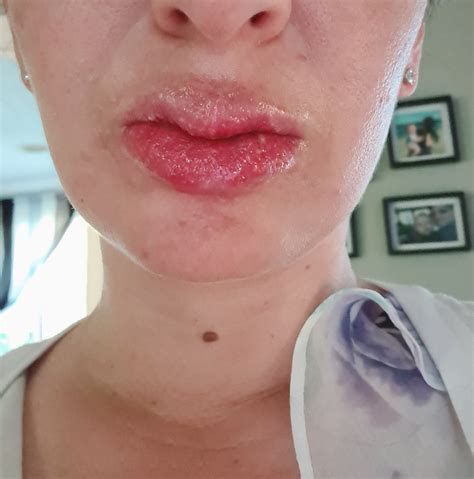 What are the side effects of beeswax on lips?