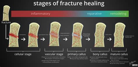 What are the signs that a broken bone is healing?