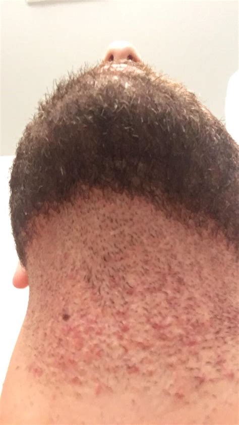 What are the spots after shaving?