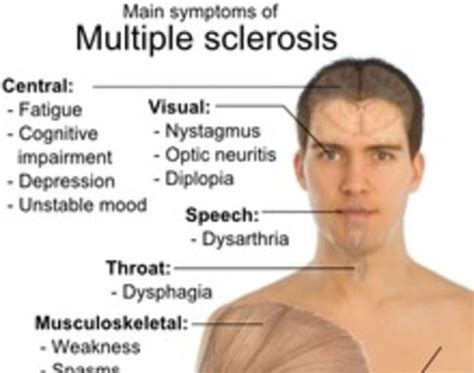 What are the symptoms of MS facial?