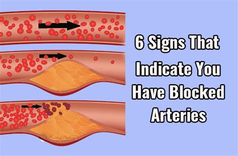 What are the symptoms of a blocked artery in your leg?