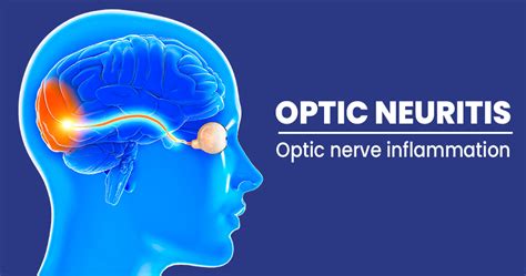 What are the symptoms of an inflamed optic nerve?