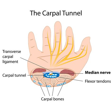 What are the three stages of carpal tunnel?