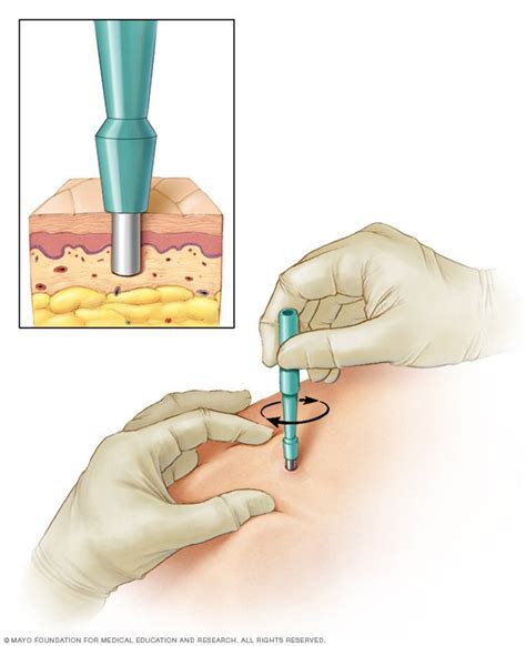 What are the three types of biopsies?