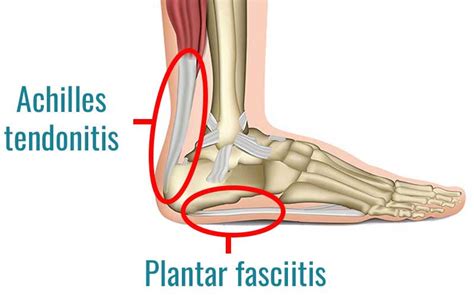 What are the two 2 types of plantar fasciitis?