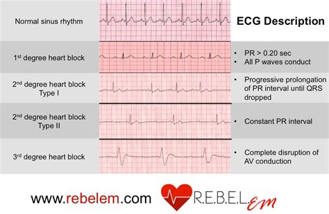 What are the two types of bradycardia?