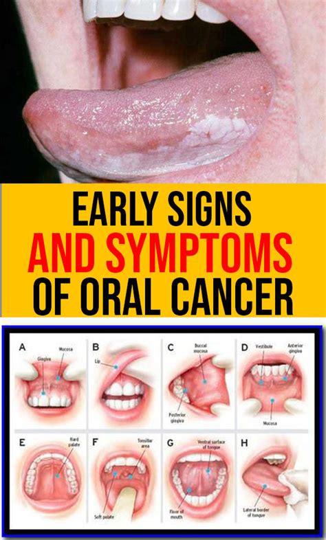 What are the warning signs of mouth cancer?