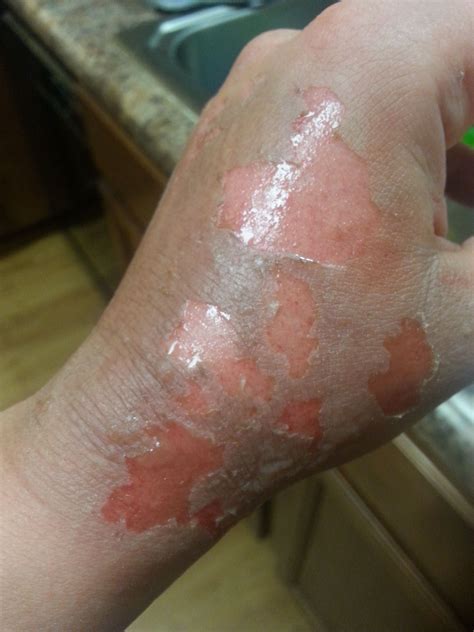 What are the white patches after burns?