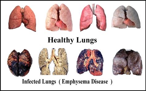 What are unhealthy lungs like?