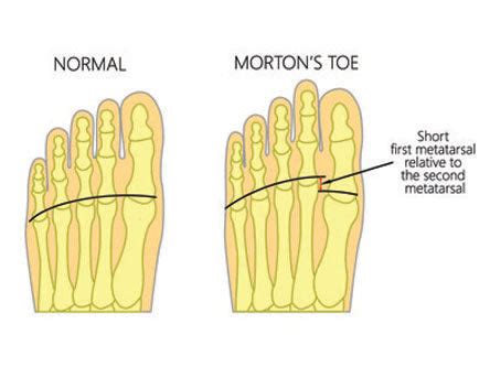 What athletes have Morton's toe?