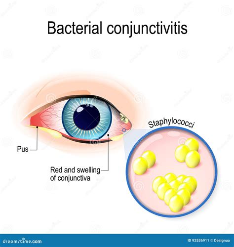 What bacteria is found in the eyes?