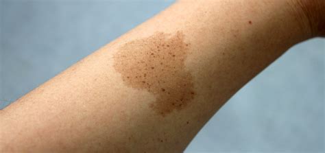 What birthmarks are permanent?