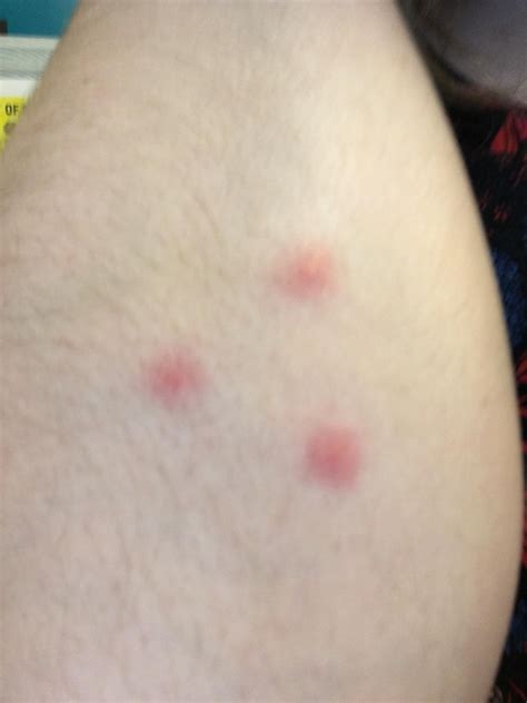 What bug bite has 3 dots in a triangle?