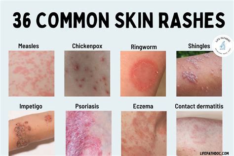 What calms a skin rash?