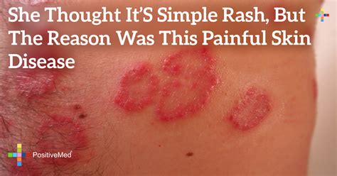 What calms down a rash?