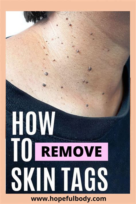 What can I eat to get rid of skin tags?
