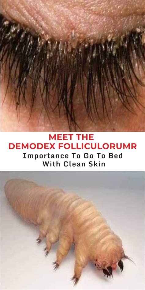 What can be mistaken for Demodex?